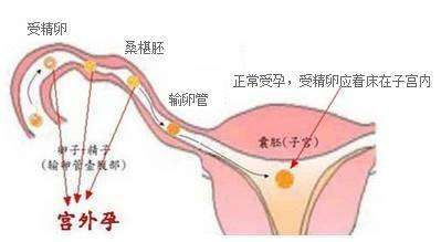 带避孕环的妇女应多补铁